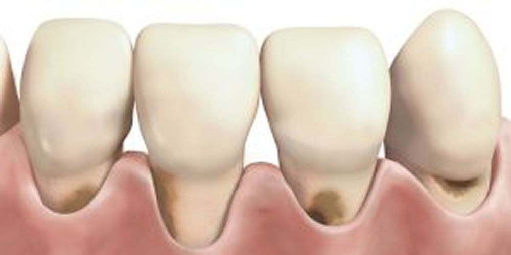 根面虫歯（大人虫歯）を予防するためのポイント