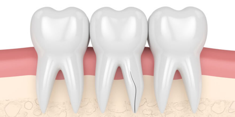 抜歯の可能性が高い歯根破折の原因