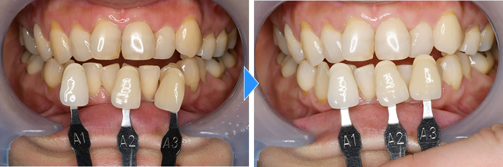 鹿児島の歯医者、ながやまデンタルクリニックのホワイトニング