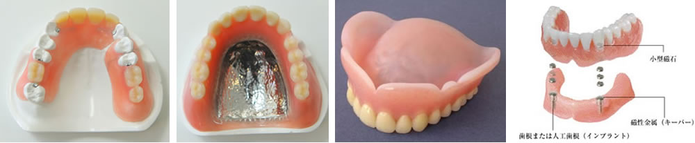 鹿児島の歯医者、ながやまデンタルクリニックの入れ歯治療