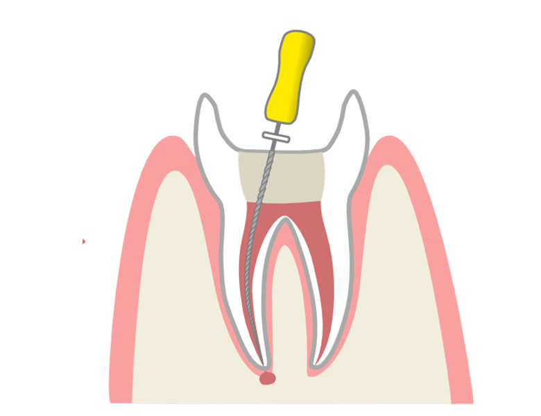 鹿児島の歯医者、ながやまデンタルクリニックの根管治療