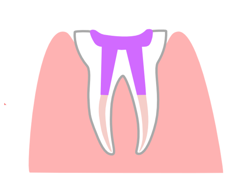 鹿児島の歯医者、ながやまデンタルクリニックの根管治療