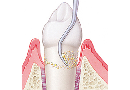 鹿児島の歯医者、ながやまデンタルクリニックの歯周病治療